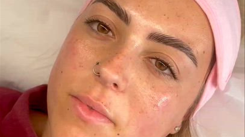 Dermaplaning 