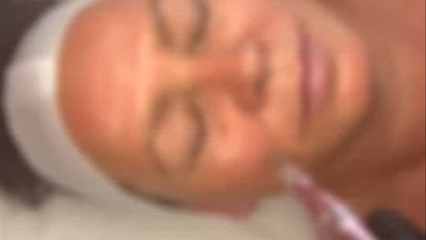 Microneedling